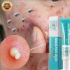 Salicylic Acid Acne Treatment Cream Shrink Pore Remove Blackheads Scars Acne Marks Spots Oil Control Whitening Korean Skin Care